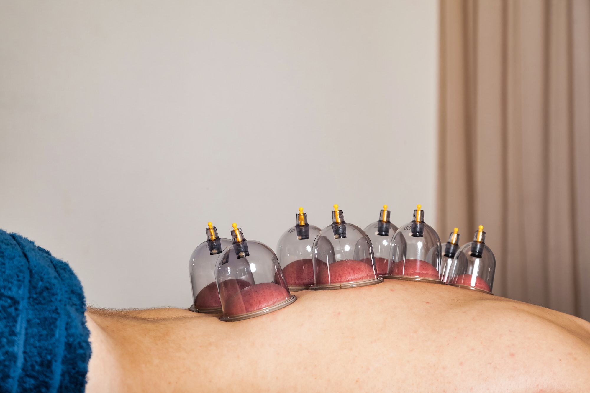 Close-up for multiple vacuum cups on human back, medical cupping therapy